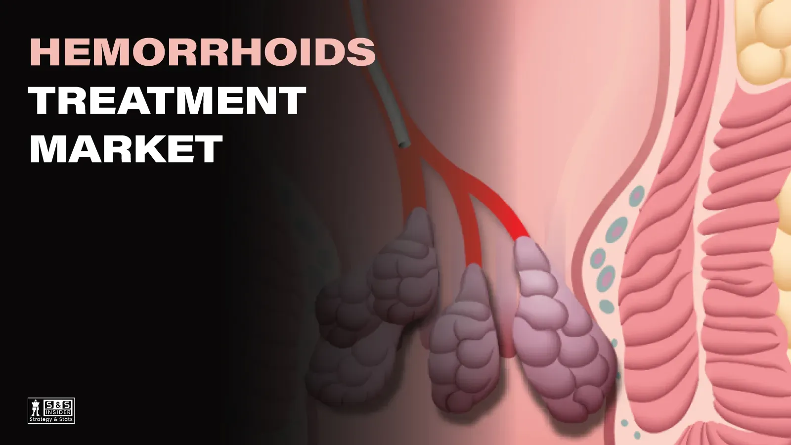 Hemorrhoids Treatment Market