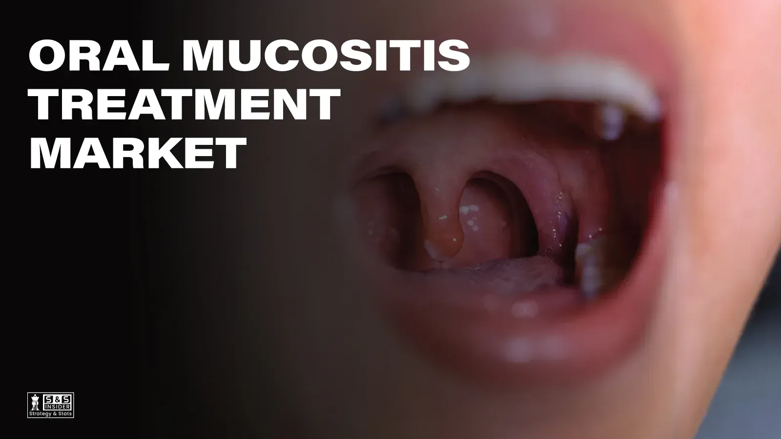 Oral Mucositis treatment Market
