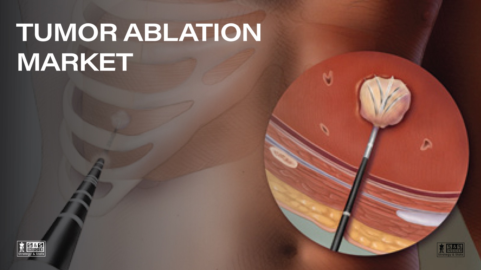 Tumour Ablation Market