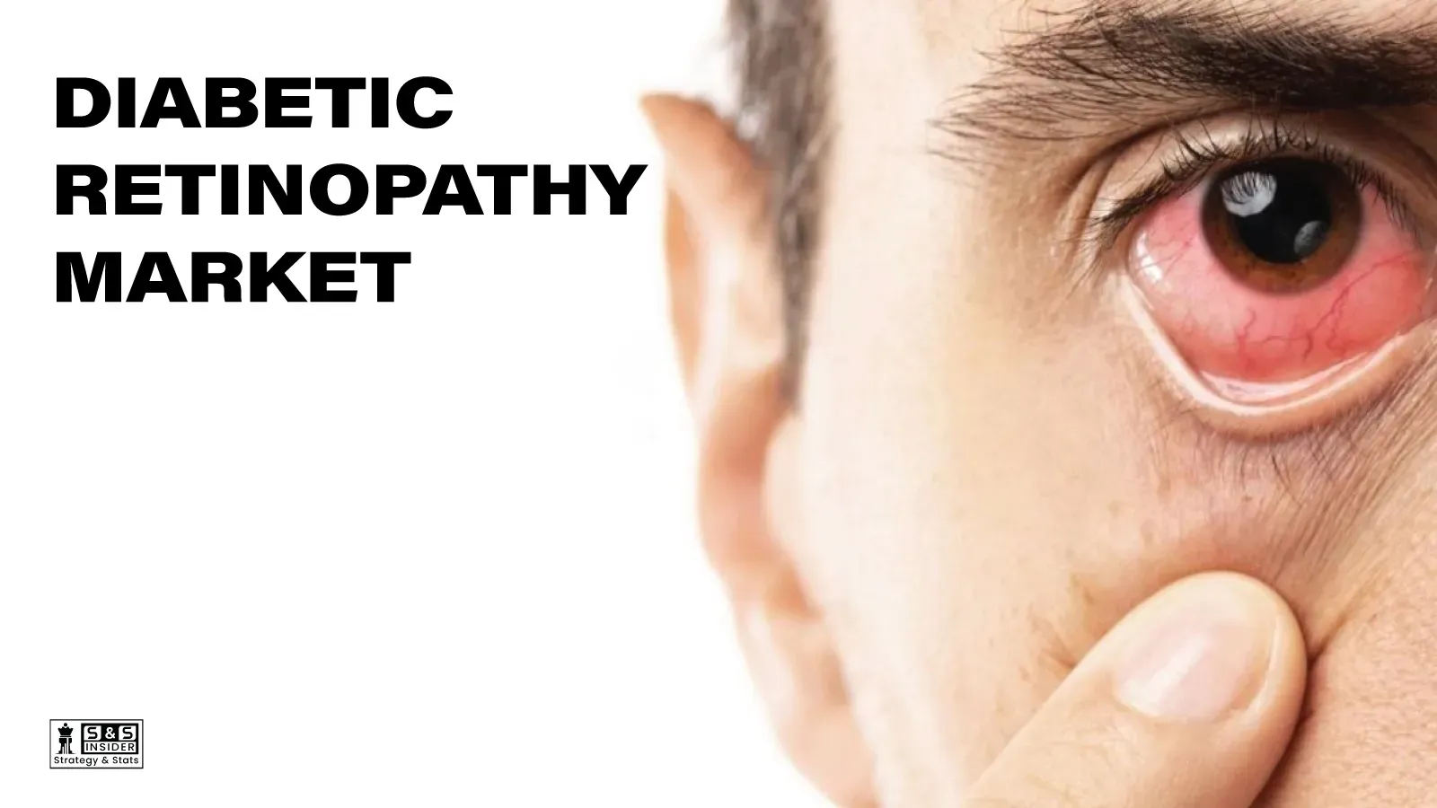 Diabetic Retinopathy Market